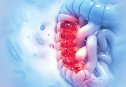 Những ai có nguy cơ mắc ung thư đại tràng